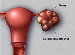 Ovarian-Cysts-Causes-Diagnosis-Best-Treatment-option-Best-Homeopathic-gynecologist-in-Pakisan-Dr.-Qaisar-Ahmed-Al-Haytham-clinic-Risalpur