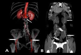 Aortoiliac Occlusive Disease A Silent Syndrome Bmj Case Reports