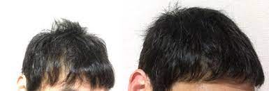 薄毛ハゲ改善育毛 育毛 薄毛 発毛