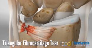 Image result for TFCC Steroid Injection