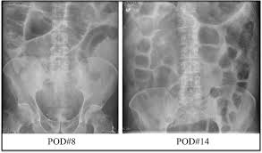 Image result for Adynamic Ileus