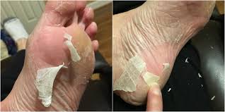 The 12 best foot peels to exfoliate rough, calloused feet, according to experts. Baby Foot Peel Review What To Know About Baby Foot Peel And If It S Safe