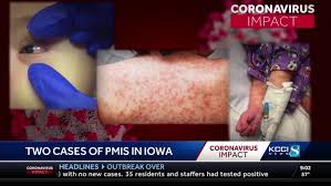 Image result for Multisystem Inflammatory Syndrome