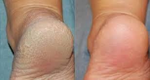 Comment Avoir Les Pieds Doux Et Soyeux En Utilisant Le Bicarbonate De Soude Bicarbonate De Soude Pieds Doux Taches Brunes