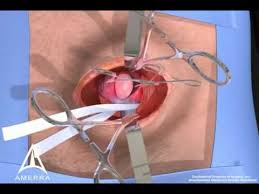 Inguinal Hernia Surgery 3d Medical Animation Open Procedure Hernia Repair Hernia Inguinal Medical