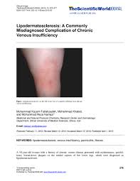 Image result for Lipodermatosclerosis