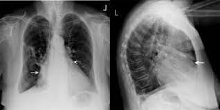 This drug reduces inflammation in the body. Pericardite Troubles Cardiovasculaires Edition Professionnelle Du Manuel Msd