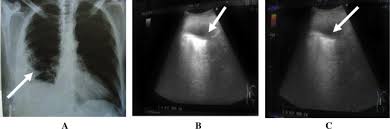 Ultrasound guidance decreases complications and improves the cost of care among patients undergoing thoracentesis and. Discrimination Between Pleural Thickening And Minimal Pleural Effusion Using Color Doppler Chest Ultrasonography Sciencedirect