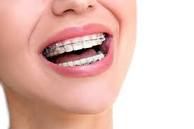 In general, cosmetic braces can take between six months to more than 24 months to complete. Teeth Straightening 6 Reasons Adults Should Get Orthodontic Treatments Leawood Ks Orthodontist Dr Laura S Orthodontics