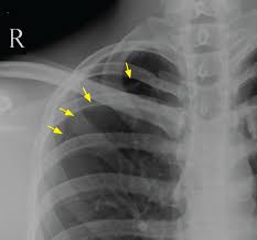 Image result for Pneumothorax