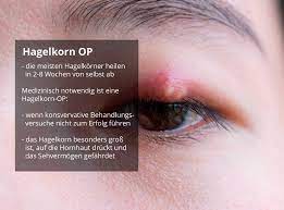 Kann ein hagelkorn auch operiert werden? Wann Wird Ein Hagelkorn Operiert Und Wie Sieht Die Op Aus