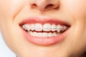 However, metal braces can interrupt signals in imaging tests. Braces Colors How To Pick The Best Braces Color For Your Teeth Jefferson Dental Orthodontics