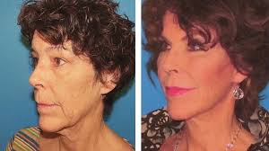 Facial Plastic Surgery