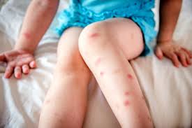 À l'âge adulte, elles mesurent de 4 à 7 millimètres de long, soit environ la taille d'un pépin de pomme. La Piqure De Punaise De Lit Photos Consequence Traitement