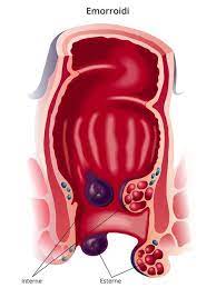 Emorroidi Sintomi Cause Tutti I Rimedi Cure Naturali It