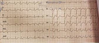 Image result for Magnesium Overdose