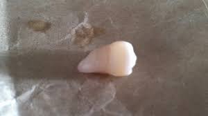 I Have Pulled Out A Wisdom Tooth In Hospital I Will Pull Out The Rest Of The Wisdom Teeth In The Next Month I Ca Wisdom Tooth Extraction Wisdom Teeth Food Now