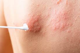 Image result for shingles in children