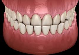 Is A Slight Underbite Worth Getting Fixed Quora