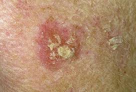 Seltener stark bösartiger (hochmaligner) tumor der haut mit hoher rezidivrate, vorkommen v.a. Http Www Hautklinik Mainz De Fileadmin Kliniken Haut Dokumente Hautkrebszentrum Merkmale Heller Hautkrebs Pdf Sa U Ei F6glvjqsliwkygp 4oliag Ved 0cewqfjal Usg Afqjcng6ioa B6vogru1b0l2x5k3edujeg