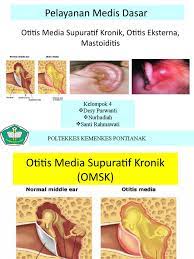 Membran timpani, kavum timpani, processus mastoideus, dan tht rumah sakit di indonesia dengan prevalensi adalah 3,8 %.7 1.4 klasifikasi otitis media supuratif kronik dapat dibagi menjadi 2 jenis. Otitis Media Supuratif Kronik Omsk