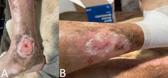 Image result for Systemic Sclerosis