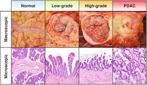 Jun 06, 2021 · the pancreatic cancer action network can connect you with a pancreatic cancer survivor who can provide support by phone or email. Early Detection Of Pancreatic Cancer Opportunities And Challenges Gastroenterology