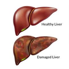 Ginger Tea Dissolves Kidney Stones Cleanses Liver And Kills Cancer Cells Chennai S Premier Hospital For Treatment Of Kidney Stones