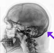 Maybe you would like to learn more about one of these? Hard Lump On Back Of Head What Causes Hard Scalp Bumps When To See A Doctor