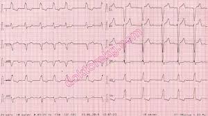 Image result for Left Bundle Branch Block