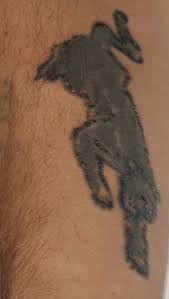 Doremus 4 also noted that tattoos can make it more difficult to detect skin. Inflammatory Tattoo Reaction Dermatology Advisor