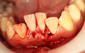 Image result for Tooth Luxation