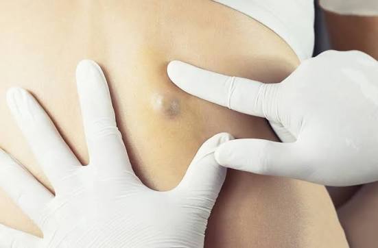 Can Cysts Be a Health Concern?: Sanford Dermatology: Medical Dermatology