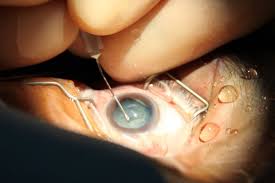 Katarakt Operation Www Augenmedizin At