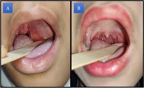 Image result for Paropsia