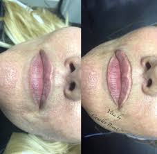 Only certain types of tattoo removal laser machines can safely and effectively remove lip tattoos and lip liner tattoos. Laser Tattoo Removal London