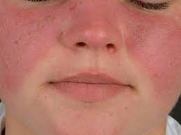 Vague symptoms can make this autoimmune disease. Lupus Erythematodes Systemischer Altmeyers Enzyklopadie Fachbereich Innere Medizin