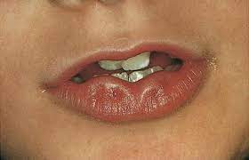 Durch den kontakt werden vor allem bakterielle entzündungen begünstigt. Erkrankungen Der Lippen Und Der Mundhohle Springerlink