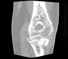 Burkhart, k., wegmann, k., ries, c. Radiuskopfchenfraktur Symptome Diagnose Und Behandlung Gelenk Klinik De