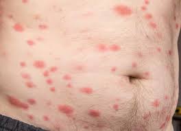 Image result for bedbug bites look like