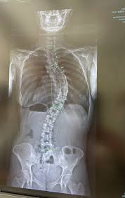 側 弯症 ブログ アメーバ