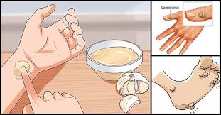 Ni serius bisa pke bawang putih soalnyabudah semiggu mata ikan di telapak kaki sakitnya bukan maen buat jlan nyut nyutan nyeri. Begini Cara Mudah Untuk Hilangkan Kutil Dan Mata Ikan Cukup Gunakan Bawang Putih Semua Halaman Hype