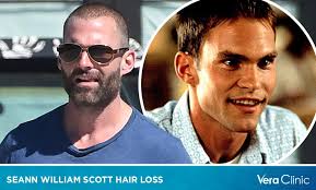 Seann William Scott Hair Loss: Debunking Myths