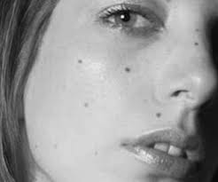 Comment Ajouter Ou Retirer Un Grain De Beaute Au Centre De Medecine Esthetique Cleage A Lyon Chirurgien Esthetique Serieux A Lyon Centre Cleage