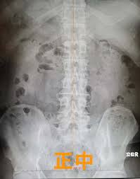 ドッグ ライン 腰椎