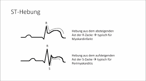 Zurzeit ist bei einem akuten infarkt. Ekg Crashkurs Teil 5 Herzinfarkt Youtube