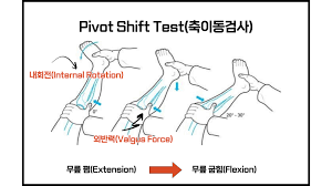 Image result for Pivot Shift Test