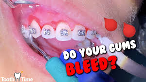 There are several ways to prevent gum inflammation with braces. Braces Gum Swelling Bleeding Why And What To Do Tooth Time Family Dentistry New Braunfels Youtube