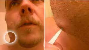 Les boutons du visage chez l'homme et la femme. Il Se Perce Un Bouton Apparu Apres Un Abces Dentaire