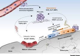 In 13%, the cancer has spread to regional lymph historically, systemic therapy for metastatic and advanced prostate cancer has involved for locally advanced prostate cancer (clinical stage t3), the accepted treatment recommendation is. Emerging Players In Prostate Cancer Bone Niche Communication Trends In Cancer